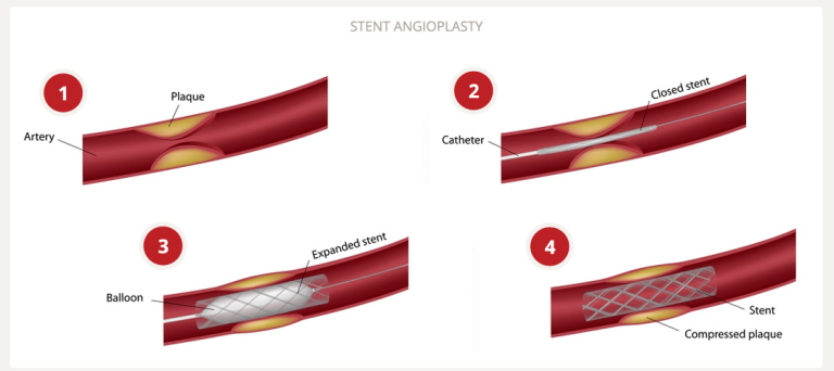 Peripheral Artery Disease (PAD) Treatment | USA Vascular