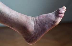 Blue, Discolored Feet: What You Should Know | USA Vascular