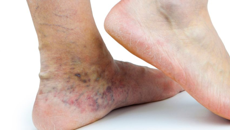 Blue Discolored Feet What You Should Know USA Vascular