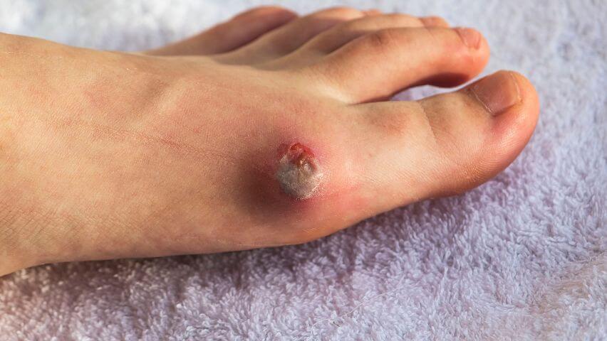 PAD Symptoms: Non-Healing Arterial Foot, Leg & Toe Ulcers